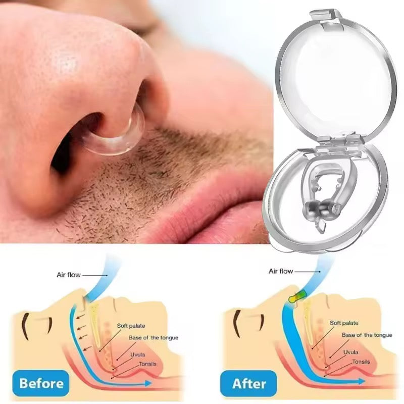 Lot de 6 clips nasaux anti-ronflement